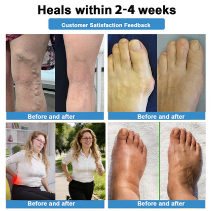 Healrize® 🦵4-in-1 Vein & Joint Nano Microneedle Advanced Therapy Patch🔥Instant Relief, Long-Term Results