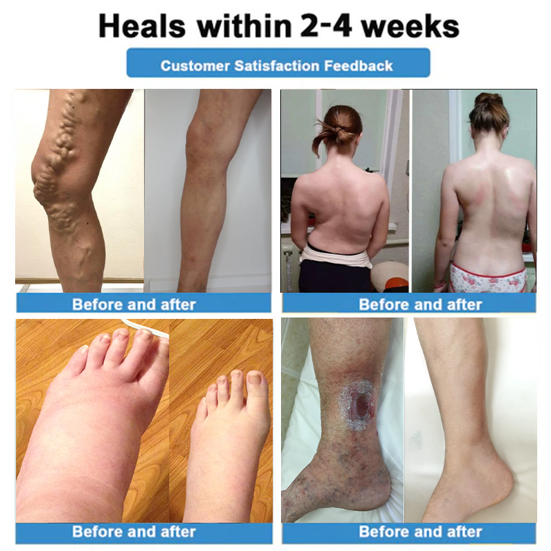 Healrize® 🦵4-in-1 Vein & Joint Nano Microneedle Advanced Therapy Patch🔥Instant Relief, Long-Term Results