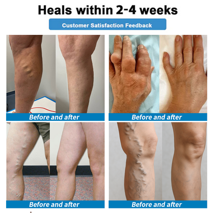 Healrize® 🦵4-in-1 Vein & Joint Nano Microneedle Advanced Therapy Patch🔥Instant Relief, Long-Term Results
