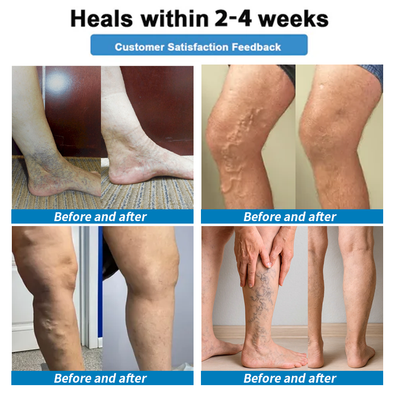 Healrize® 🦵4-in-1 Vein & Joint Nano Microneedle Advanced Therapy Patch🔥Instant Relief, Long-Term Results