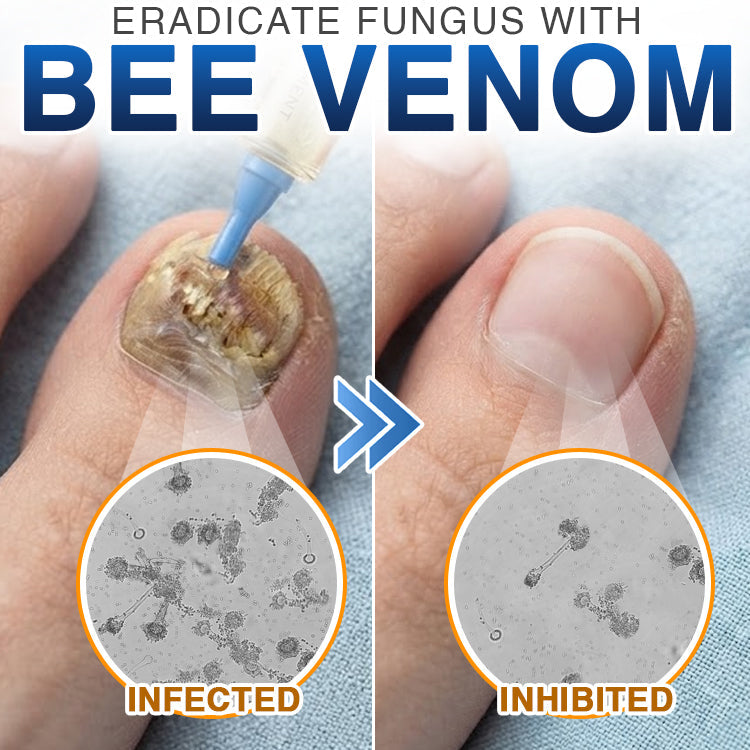 🇬🇧 𝐓𝐫𝐢𝐥𝐮𝐦𝐢𝐚® Fungi Free Bee Venom Nail Treatment 🐝