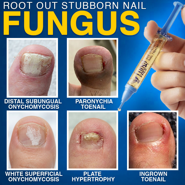 🇬🇧 𝐓𝐫𝐢𝐥𝐮𝐦𝐢𝐚® Fungi Free Bee Venom Nail Treatment 🐝