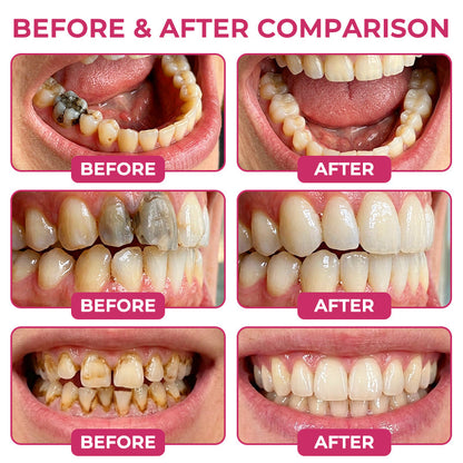 👨‍⚕️ Official Store ✨ Trilumia® DenPerm 🦷 Cavity-Repair Natural Enamel Filling Gel 🍀